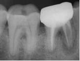 Вертикальный перелом зуба