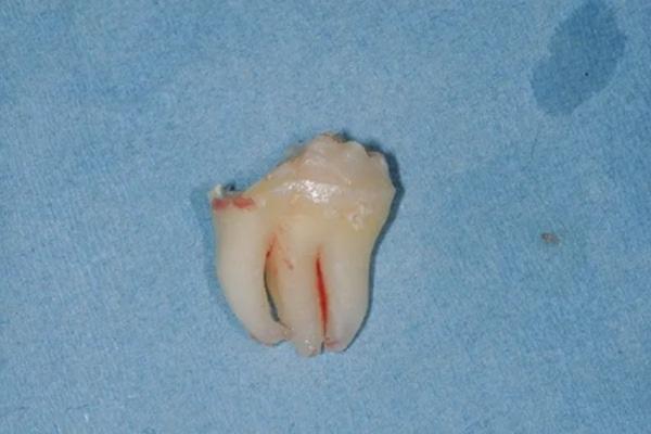 Импактный "двойной" третий моляр нижней челюсти: сращение или геминация?