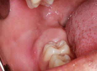 Гиперплазия зубных фолликулов - клинический случай