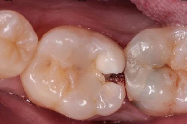 Эндодонтия 46 зуба