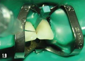 Микроинвазивное лечение кариеса зубов icon thumbnail