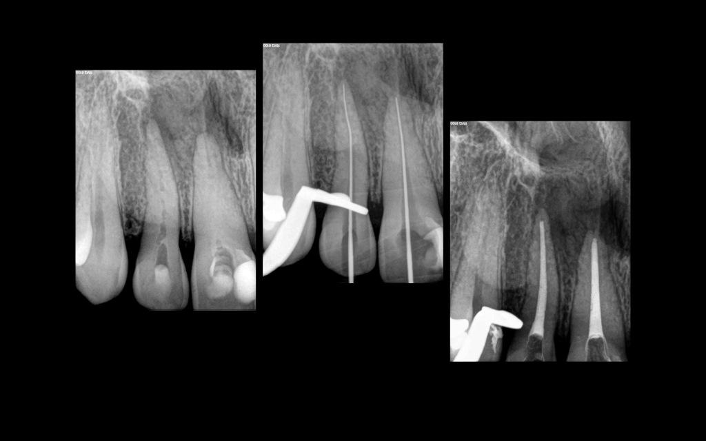 Лечение зуба кальцием сколько длится боль