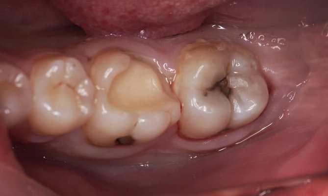 Восстановление зуба 3.6 с помощью композитной вкладки