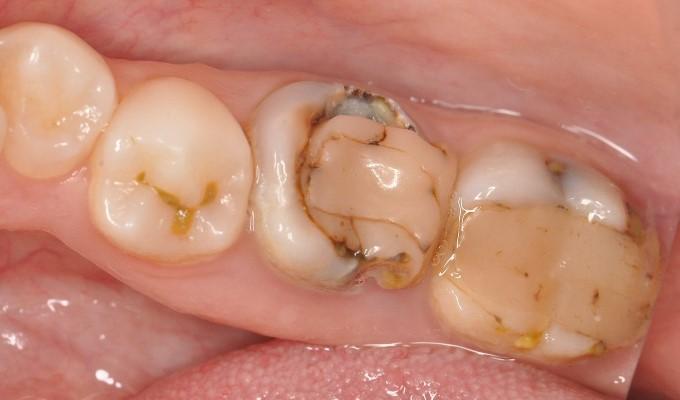 Плановая санация перед ортодонтическим и ортопедическим лечением
