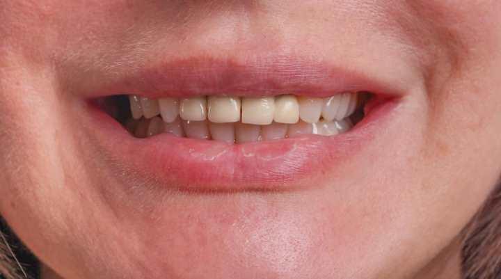 Комплексная реабилитация зубов верхней челюсти