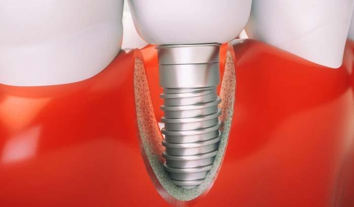 Сколько титана выделяется в ткани, окружающие зубной имплантат?
