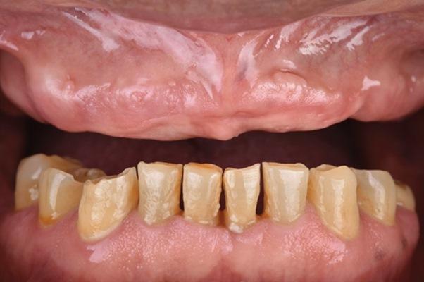 Цифровая имплантация у пациента с полным отсутствием зубов