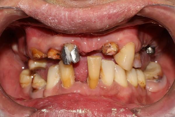 Ремоделирование улыбки с использование металлокерамических коронок с опорой на зубы и имплантаты