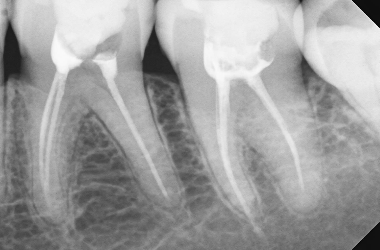 Пломбировка корневых каналов. Запломбированные каналы на рентгене. Запломбированные каналы зуба на рентгене. Запломбированные корневые каналы на рентгене. Пломбировка каналов зуба рентген.