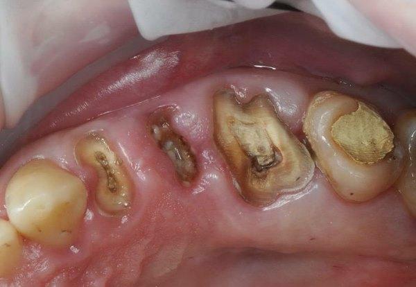 Удаление 24, 25 и 26 зуба с одномоментной имплантацией в области 24 и 26 зуба