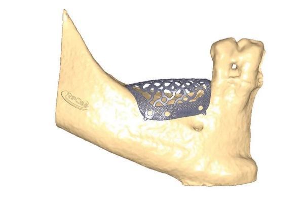 Применение клеточной костной матрицы и индивидуального титанового сетчатого каркаса для вертикальной аугментации кости в области бокового отдела нижней челюсти