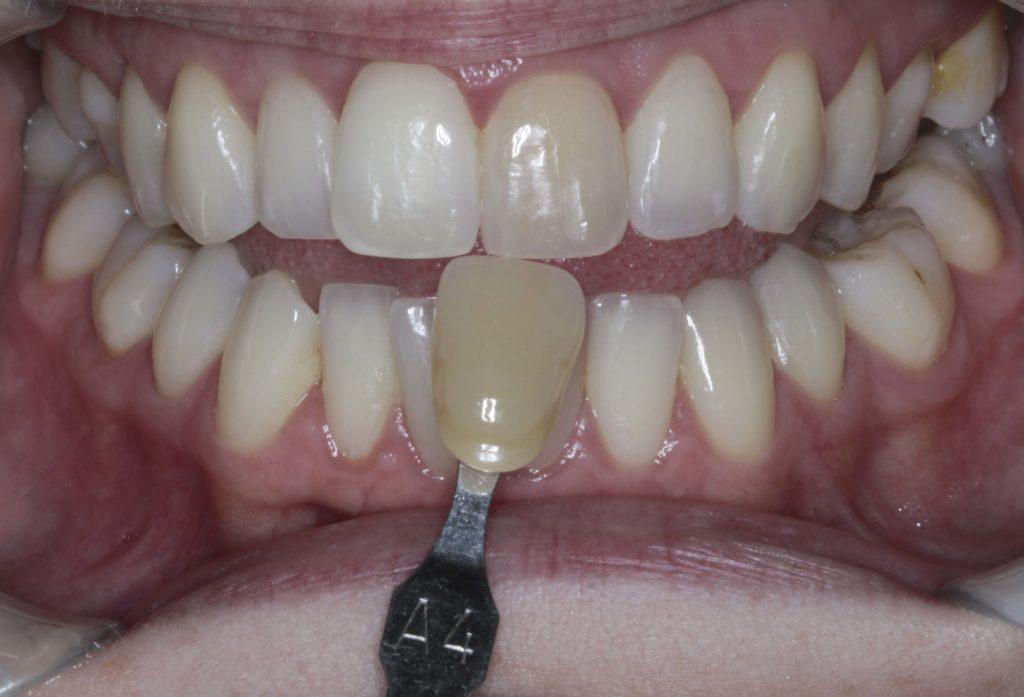 Лечение дисколорита одного зуба
