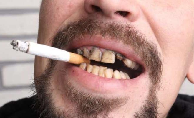 Влияние курения на лечение пародонтита