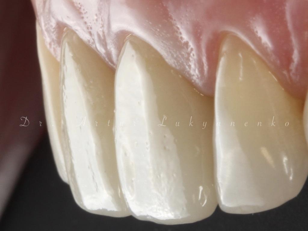 Лечение зубов после снятия коронок thumbnail