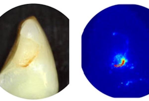 Какой метод визуализации использовать для контроля активности кариеса зубов после реставрации