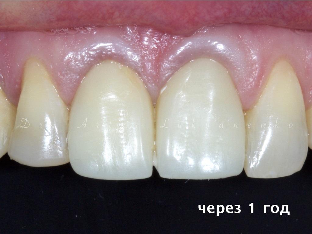 Лечение зубов после снятия коронок
