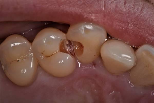 Реставрация с восстановлением контактных пунктов зубов 2.3 и 2.4