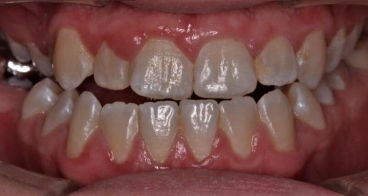 Важность коммуникации между ортодонтом и хирургом при лечении пациентов с аномалиями окклюзии скелетной этиологии