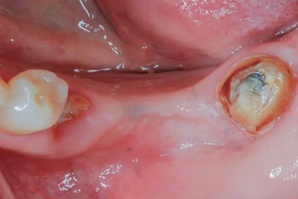 Направленная костная регенерация: новое использование фиксирующих винтов как альтернатива использованию надкостницы для стабилизации мембраны с помощью швов