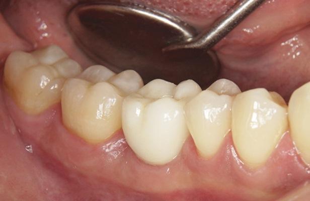 От минимально инвазивного удаления зубов до окончательной реставрации: полный рабочий процесс с использованием микроскопии и цифровых технологий для лечения на одиночном имплантате