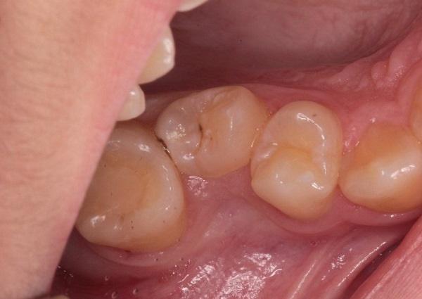 Подготовка к ортодонтическому лечению
