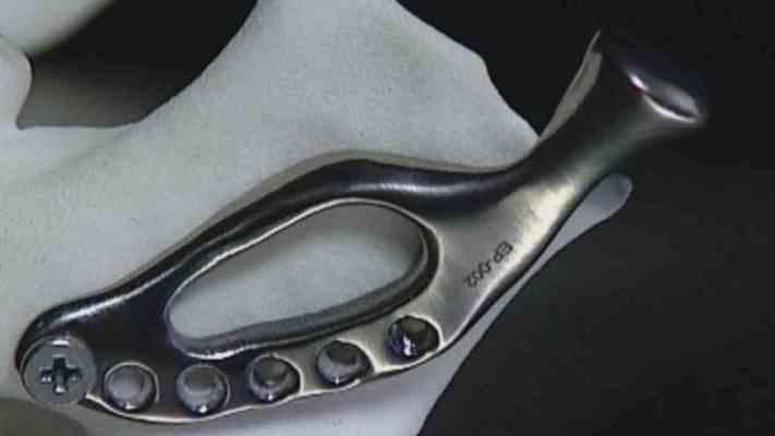 В Индии провели операцию по реконструкции челюсти из титанового имплантата, напечатанного на 3D-принтере