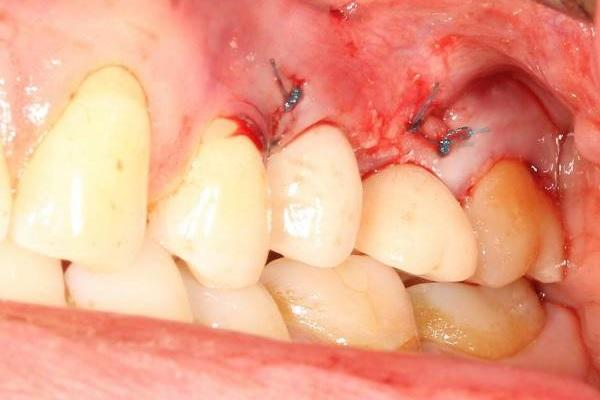 Удаление, немедленная имплантация в область 2.5 зуба с немедленной нагрузкой