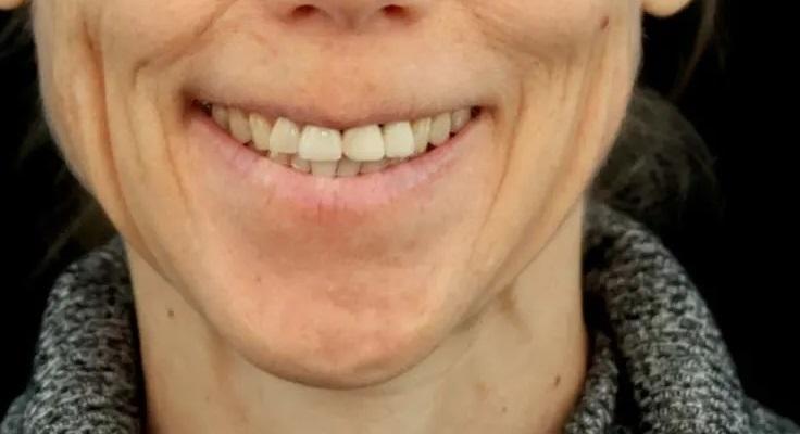 Эстетико-функциональная реабилитация выраженно стертых зубов с использованием фасциально-ориентированного планирования лечения и цифрового протокола