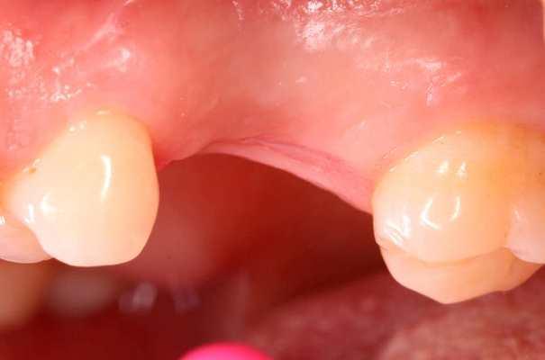 Пирсинг в полости рта как противопоказание к имплантации с одномоментной нагрузкой