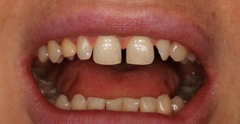 Закрытие диастемы композитом без препарирования зубов
