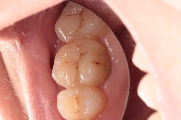 Улучшение прогноза выживаемости зуба путём перекрытия объемной композитной реставрации коронкой