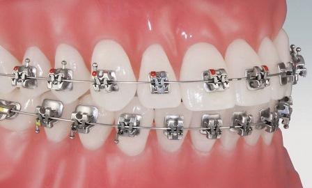 Ортодонтическое лечение у пациентов с тяжелыми формами пародонтитов: клиническое исследование