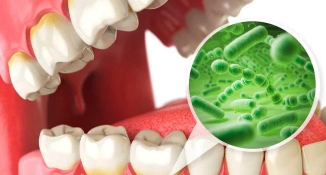 Исследование выявило новые виды бактерий, участвующие в образовании кариеса зубов