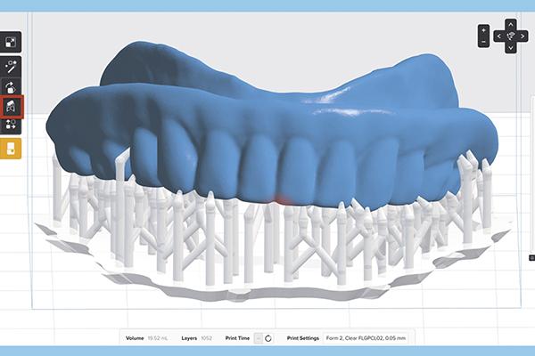 Цифровой протокол дупликации съемного протеза (2239) - Ортопедия - Новости и статьи по стоматологии - Профессиональный стоматологический портал (сайт) «Клуб стоматологов»