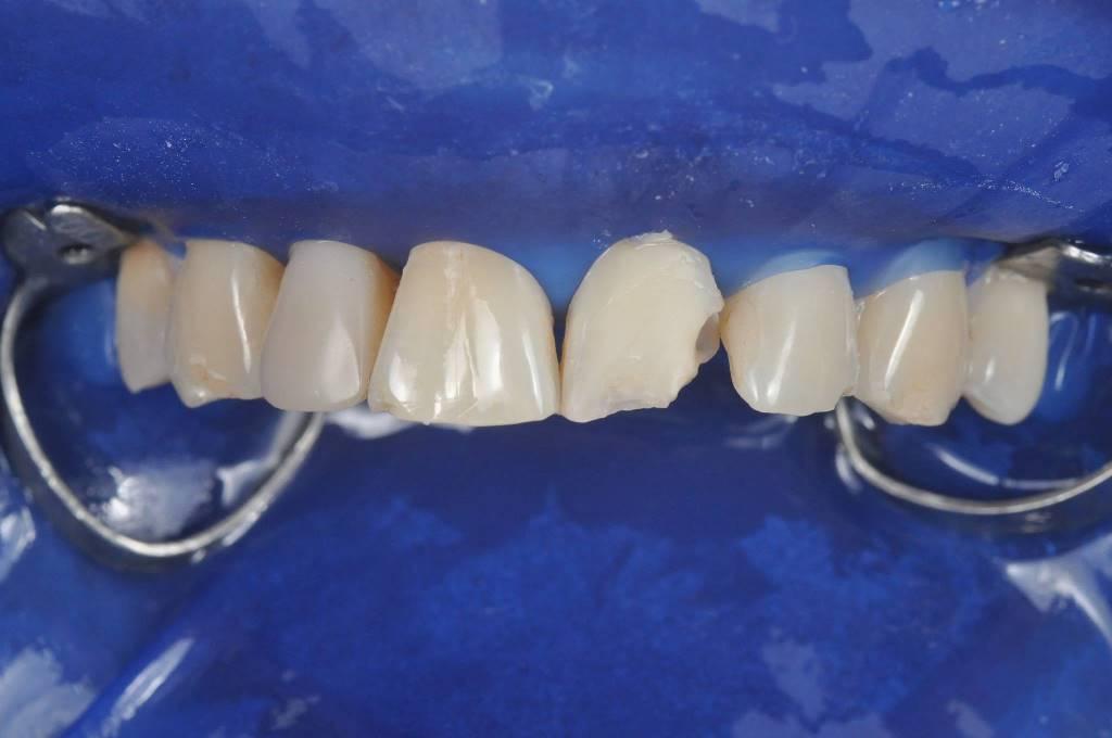 Цена композитной реставрации. Силиконовый ключ в стоматологии. Восстановление композитом зубов. Силиконовый ключ в ортопедической стоматологии. Восстановление зуба по ключу.