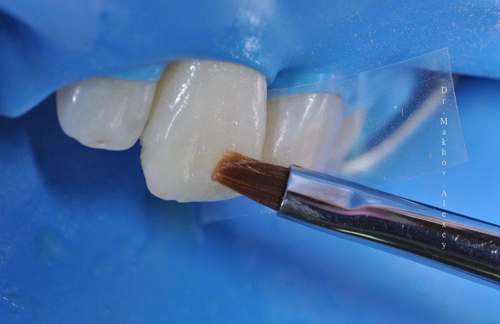 Материал для реставрации зубов