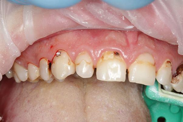 Кариес дентина зубов 1.5 - 2.1