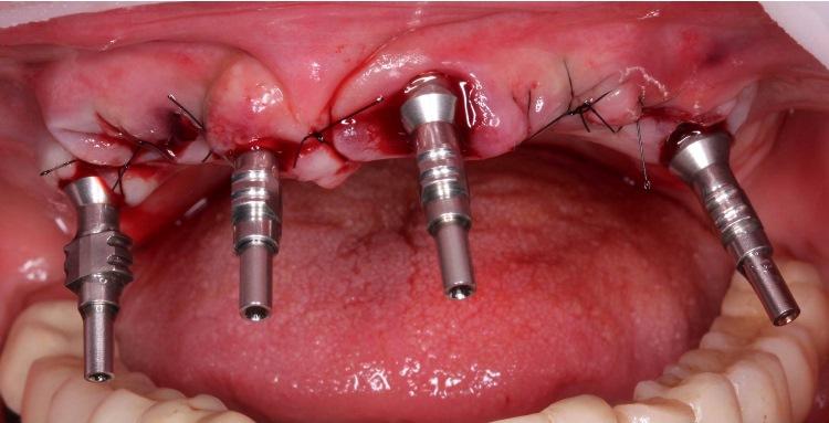 Восстановление верхнего зубного ряда на четырёх имплантатах