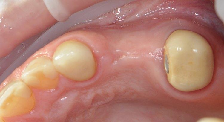 Инсталляция 2-ух дентальных имплантатов на верхней челюсти в область 24 и 25 зубов