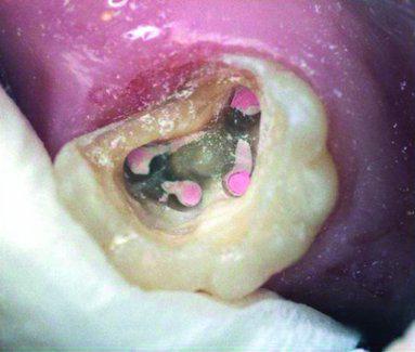 Лечение 2 верхнего зуба