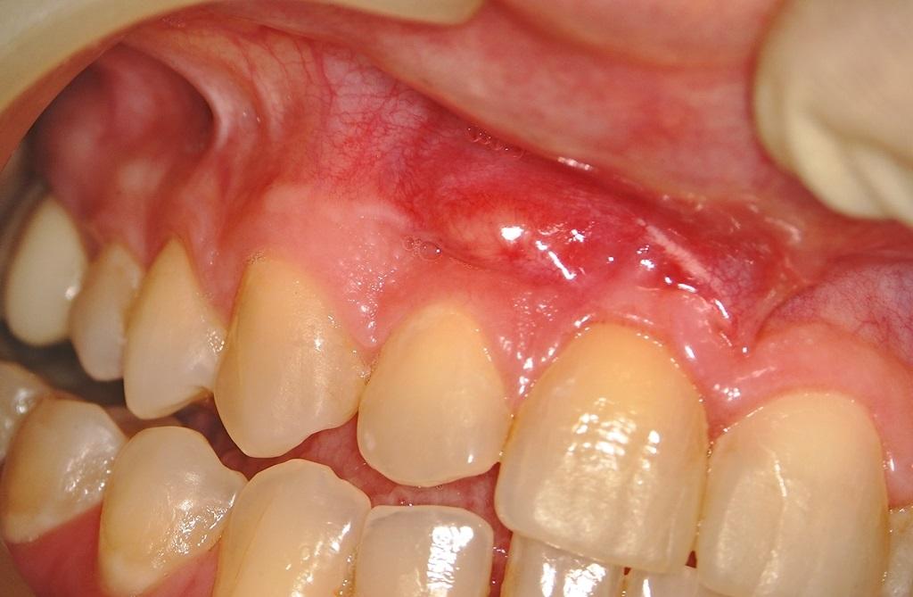 При лечении зуба положили кальций