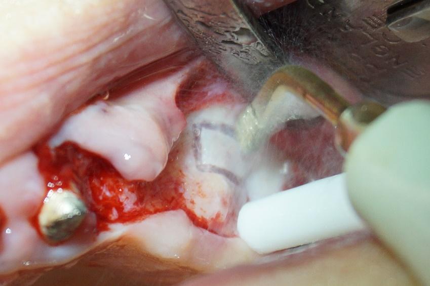 Пьезохирургические аппараты: инновации на службе стоматолога