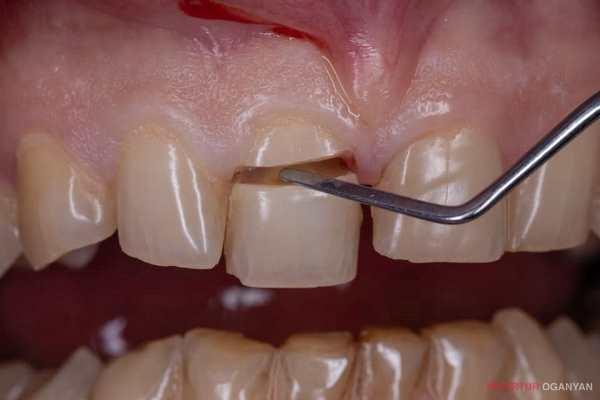 Тяжелый перелом коронки зуба с обнажением пульпы